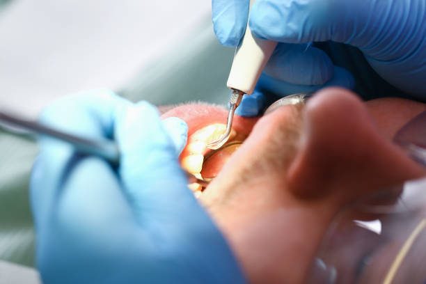 Best Emergency Treatment for Dental Infections or Abscesses in Saylorsburg, PA