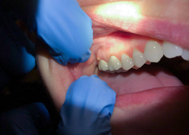 Best Same-Day Emergency Dental Services in Saylorsburg, PA
