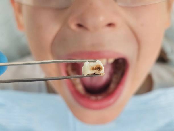 Best Emergency Dental Care for Broken or Chipped Teeth in Saylorsburg, PA